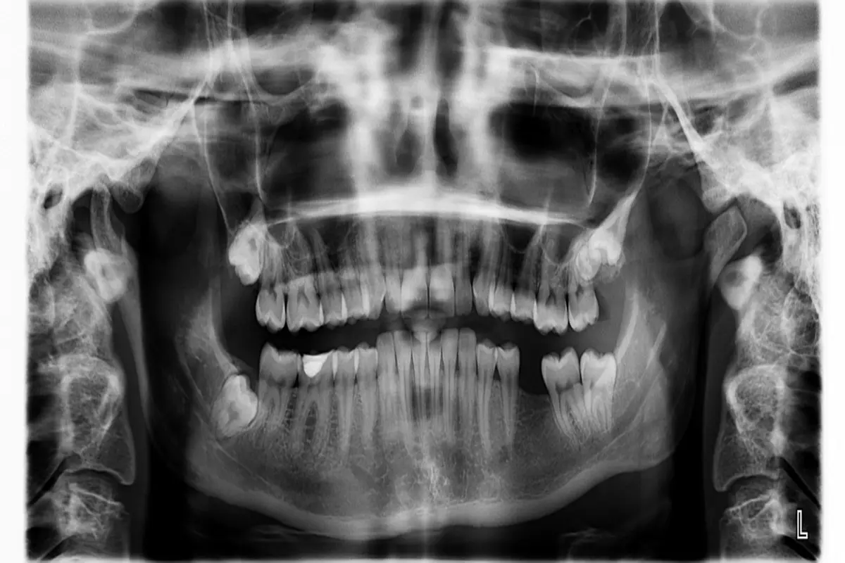 sonhar com dente caindo da boca